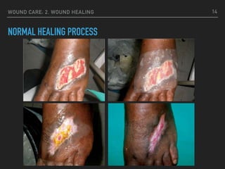 WOUND CARE: 2. WOUND HEALING
NORMAL HEALING PROCESS
14
 