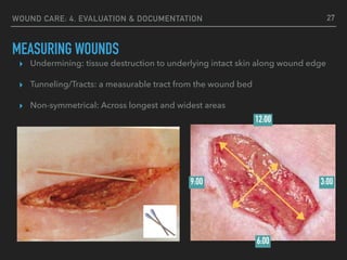 WOUND CARE: 4. EVALUATION & DOCUMENTATION
MEASURING WOUNDS
27
3:009:00
12:00
6:00
▸ Undermining: tissue destruction to underlying intact skin along wound edge
▸ Tunneling/Tracts: a measurable tract from the wound bed
▸ Non-symmetrical: Across longest and widest areas
 