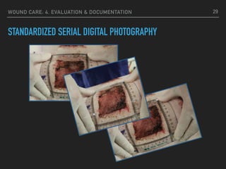 WOUND CARE: 4. EVALUATION & DOCUMENTATION
STANDARDIZED SERIAL DIGITAL PHOTOGRAPHY
29
 