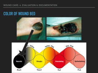 WOUND CARE: 4. EVALUATION & DOCUMENTATION
COLOR OF WOUND BED
 