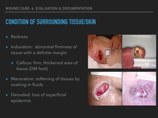 WOUND CARE: 4. EVALUATION & DOCUMENTATION
CONDITION OF SURROUNDING TISSUE/SKIN
▸ Redness
▸ Induration: abnormal ﬁrmness of
tissue with a deﬁnite margin
▸ Callous: ﬁrm, thickened area of
tissue (DM foot)
▸ Maceration: softening of tissues by
soaking in ﬂuids
▸ Denuded: loss of superﬁcial
epidermis
 