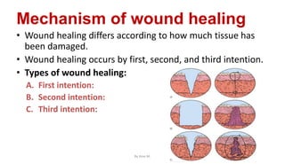 Mechanism of wound healing
• Wound healing differs according to how much tissue has
been damaged.
• Wound healing occurs by first, second, and third intention.
• Types of wound healing:
A. First intention:
B. Second intention:
C. Third intention:
By Ame M.
 