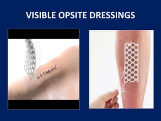 Opsite Rash Cause Wound care essentials | PPTX