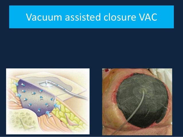 wound care for nurses