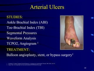 Arterial Ulcers
STUDIES:
Ankle Brachial Index (ABI)
Toe-Brachial Index (TBI)
Segmental Pressures
Waveform Analysis
TCPO2, Angiogram 1
10
1. D Holtman, V Gahtan. Peripheral Arterial Perfusion: is it adequate for wound healing? Wounds. 2008: 20(8): 230-235.
2. Image: http://www.angiologist.com/wp-content/uploads/2010/08/Rutherford_6.jpg
TREATMENT:
Balloon angioplasty, stent, or bypass surgery1
 