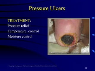 Pressure Ulcers
TREATMENT:
Pressure relief
Temperature control
Moisture control
11
1. Image: http://1.bp.blogspot.com/--f1gXWksxF0/TxUdgP8iwtI/AAAAAAAAA-I/O_4nc6O_CIU/s1600/IMG_0418.JPG
 