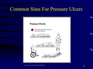Common Sites For Pressure Ulcers
12
http://img.docstoccdn.com/thumb/orig/41604968.png
 