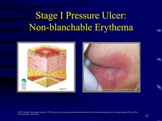 Stage I Pressure Ulcer:
Non-blanchable Erythema
13
NPUAP Pressure Ulcer Stages/Categories. NPUAP.org http://www.npuap.org/resources/educational-and-clinical-resources/npuap-pressure-ulcer-stagescategories/Pressure Ulcer
Prevention Points. NPUAP.org
 