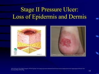 Stage II Pressure Ulcer:
Loss of Epidermis and Dermis
14
NPUAP Pressure Ulcer Stages/Categories. NPUAP.org http://www.npuap.org/resources/educational-and-clinical-resources/npuap-pressure-ulcer-stagescategories/Pressure Ulcer
Prevention Points. NPUAP.org
 