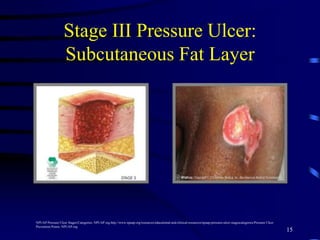 Stage III Pressure Ulcer:
Subcutaneous Fat Layer
15
NPUAP Pressure Ulcer Stages/Categories. NPUAP.org http://www.npuap.org/resources/educational-and-clinical-resources/npuap-pressure-ulcer-stagescategories/Pressure Ulcer
Prevention Points. NPUAP.org
 
