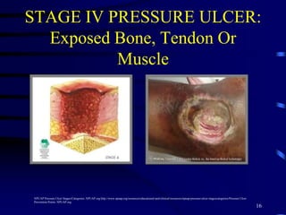 STAGE IV PRESSURE ULCER:
Exposed Bone, Tendon Or
Muscle
16
NPUAP Pressure Ulcer Stages/Categories. NPUAP.org http://www.npuap.org/resources/educational-and-clinical-resources/npuap-pressure-ulcer-stagescategories/Pressure Ulcer
Prevention Points. NPUAP.org
 