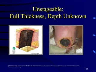 Unstageable:
Full Thickness, Depth Unknown
17
NPUAP Pressure Ulcer Stages/Categories. NPUAP.org http://www.npuap.org/resources/educational-and-clinical-resources/npuap-pressure-ulcer-stagescategories/Pressure Ulcer
Prevention Points. NPUAP.org
 
