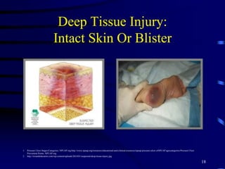 Deep Tissue Injury:
Intact Skin Or Blister
18
1. Pressure Ulcer Stages/Categories. NPUAP.org http://www.npuap.org/resources/educational-and-clinical-resources/npuap-pressure-ulcer-stNPUAP agescategories/Pressure Ulcer
Prevention Points. NPUAP.org
2. http://woundeducators.com/wp-content/uploads/2014/01/suspected-deep-tissue-injury.jpg
 