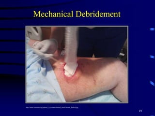 Mechanical Debridement
19
http://www.curezone.org/upload/_N_Forums/Natural_Heali/Wound_Packed.jpg
 