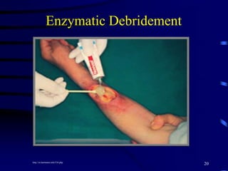 Enzymatic Debridement
20http://in.hartmann.info/534.php
 