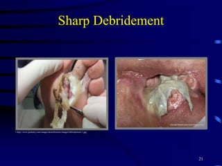 Sharp Debridement
21
1.http://www.podiatry.com/images/desertfootsite/images/Debridement-1.jpg
 