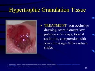 Hypertrophic Granulation Tissue
• TREATMENT: non occlusive
dressing, steroid cream low
potency x 5-7 days, topical
antibiotic, compression with
foam dressings, Silver nitrate
sticks.
23
1. Sephen-Haynes, J., Hampton S. Achieing effective outcomes in patients with over granulation: wound care alliance UK. www.wcauk.org/downloads/booklet_overgranulation.pdf
retr9eved 9/23/14
2. Image:https://woundcare-today.com/news/special-report/wound-care-today-special-report-overgranulation
 