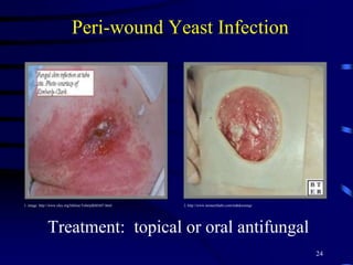 Peri-wound Yeast Infection
Treatment: topical or oral antifungal
24
1. image: http://www.oley.org/lifeline/TubetalkMA07.html 2. http://www.monarchlabs.com/mdtdressings
 