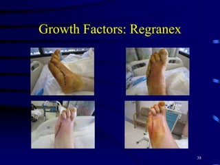 Growth Factors: Regranex
38
 