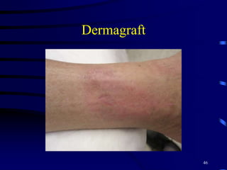 Dermagraft
46
 