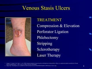 Venous Stasis Ulcers
TREATMENT
Compression & Elevation
Perforator Ligation
Phlebectomy
Stripping
Sclerotherapy
Laser Therapy
8
1. Falanga, V., Fujitani, R. M., Diaz, C., et al (1999), Systemic treatment of venous leg ulcers with high doses of pentoxifylline: efficacy in a randomized, placebo-controlled trial. Wound
Repair and Regeneration, 7: 208–213. doi: 10.1046/j.1524-475X.1999.00208.x
2. Image: http://3.bp.blogspot.com/-ye1j4BSJ5VA/Ud9-93LC0qI/AAAAAAAABx8/IBDXEDmjhHA/s1600/Chronic+Ulcers+2.jpg
 