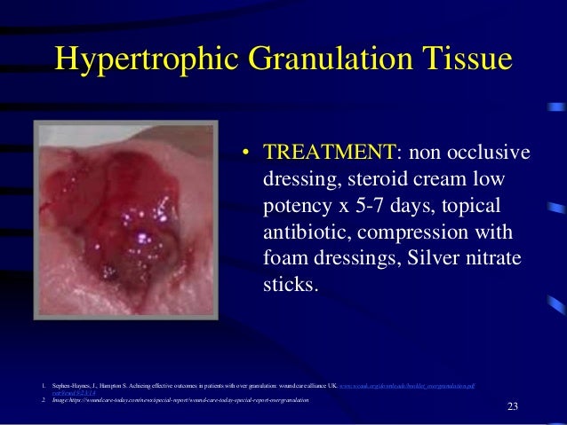 Wound Infection Natural Treatment Wound Infection Natural Treatment