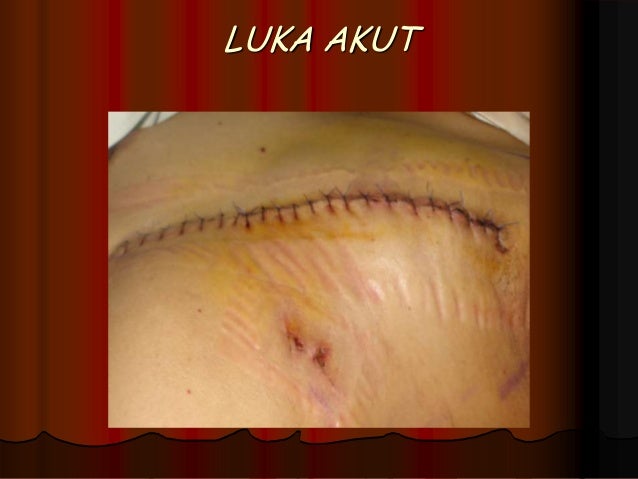Wound care new