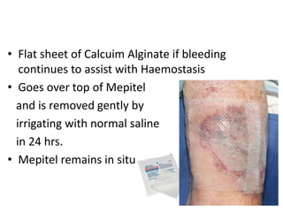 Calcuim Alginate
• Flat sheet of Calcuim Alginate if bleeding
continues to assist with Haemostasis
• Goes over top of Mepitel
and is removed gently by
irrigating with normal saline
in 24 hrs.
• Mepitel remains in situ
 