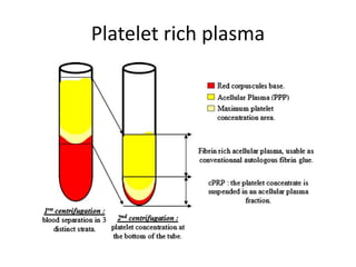 Platelet rich plasma
 