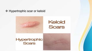 WOUND CLOSURE AND COMPLICATION | PPTX