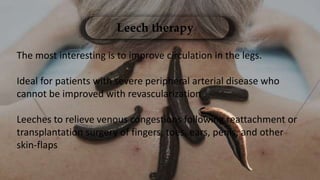 Leech therapy
The most interesting is to improve circulation in the legs.
Ideal for patients with severe peripheral arterial disease who
cannot be improved with revascularization
Leeches to relieve venous congestions following reattachment or
transplantation surgery of fingers, toes, ears, penis, and other
skin-flaps
 