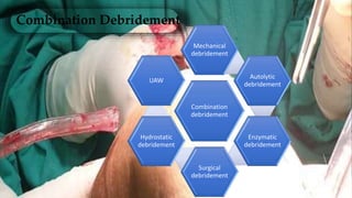 Combination Debridement
Combination
debridement
Mechanical
debridement
Autolytic
debridement
Enzymatic
debridement
Surgical
debridement
Hydrostatic
debridement
UAW
 