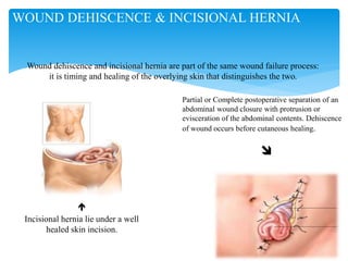 
Incisional hernia lie under a well
healed skin incision.
Partial or Complete postoperative separation of an
abdominal wound closure with protrusion or
evisceration of the abdominal contents. Dehiscence
of wound occurs before cutaneous healing.

WOUND DEHISCENCE & INCISIONAL HERNIA
Wound dehiscence and incisional hernia are part of the same wound failure process:
it is timing and healing of the overlying skin that distinguishes the two.
 