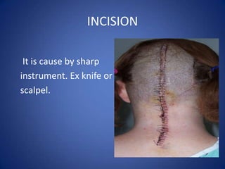 Wound dressing | PPTX