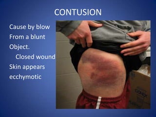 CONTUSIONCause by blowFrom a blunt Object.      Closed woundSkin appears ecchymotic
