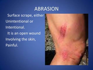 ABRASION  Surface scrape, eitherUnintentional orIntentional. It is an open wound Involving the skin, Painful.