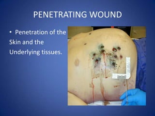 PENETRATING WOUNDPenetration of theSkin and the Underlying tissues. 