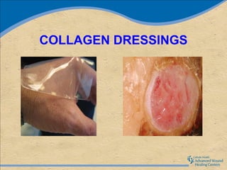 COLLAGEN DRESSINGS
 