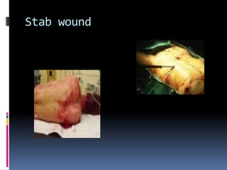 Stab wound
 