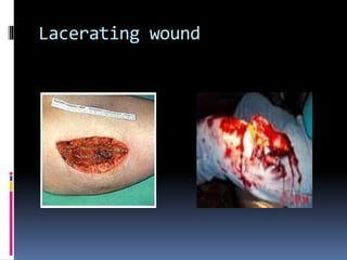 Lacerating wound
 
