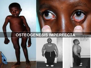 OSTEOGENESIS IMPERFECTA 