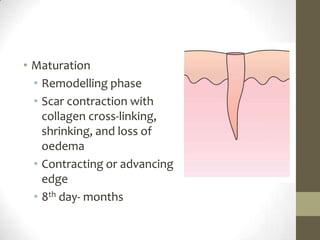 Maturation Remodelling phase Scar contraction with collagen cross-linking, shrinking, and loss of oedemaContracting or advancing edge8th day- months