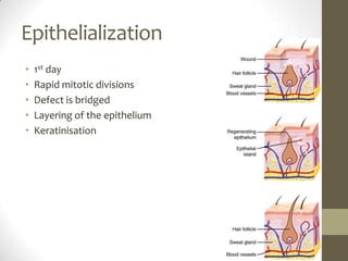 Epithelialization1st dayRapid mitotic divisionsDefect is bridgedLayering of the epitheliumKeratinisation 