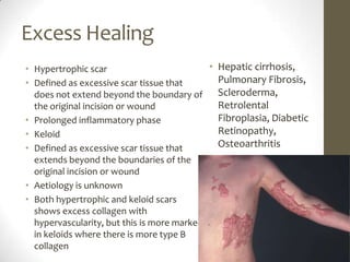 Excess HealingHepatic cirrhosis, Pulmonary Fibrosis, Scleroderma, Retrolental Fibroplasia, Diabetic Retinopathy, OsteoarthritisHypertrophic scarDefined as excessive scar tissue that does not extend beyond the boundary of the original incision or woundProlonged inflammatory phaseKeloidDefined as excessive scar tissue that extends beyond the boundaries of the original incision or woundAetiology is unknownBoth hypertrophic and keloid scars shows excess collagen with hypervascularity, but this is more marked in keloids where there is more type B collagen