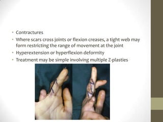 ContracturesWhere scars cross joints or flexion creases, a tight web may form restricting the range of movement at the jointHyperextension or hyperflexion deformityTreatment may be simple involving multiple Z-plasties