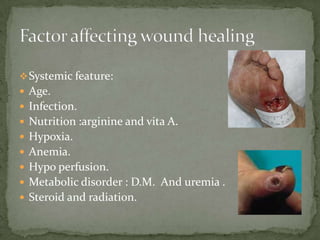  Systemic feature:
 Age.
 Infection.
 Nutrition :arginine and vita A.
 Hypoxia.
 Anemia.
 Hypo perfusion.
 Metabolic disorder : D.M. And uremia .
 Steroid and radiation.
 