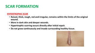 SCAR FORMATION
HYPERTROPHIC SCAR
• Raised, thick, rough, red and irregular, remains within the limits of the original
wound.
• More in dark skin and deeper wounds.
• Hypertrophic scarring occurs directly after initial repair.
• Do not grow continuously and invade surrounding healthy tissue.
 