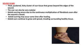 KELOID SCARS
• Thick, puckered, itchy cluster of scar tissue that grows beyond the edges of the
wound.
• The scar can also be very nodular
• Keloid scarring occurs due to the continuous multiplication of fibroblasts even after
the wound is closed.
• keloid scarring may occur some time after healing.
• Keloid scars continue to grow and spread, invading surrounding healthy tissue.
 
