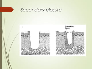 Secondary closure
 