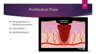 Proliferative Phase
 Angiogenesis or
Neovascularization
 Granulation
 Epithelialization
10/27/2017
30
 